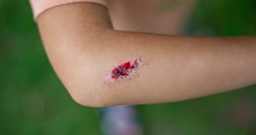 Boala infecțioasă gravă, cu mortalitate ridicată dacă nu este tratată rapid și corect. Sporii care o cauzează pot supraviețui ani de zile