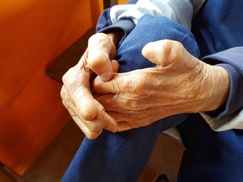Ce este lepra și cum se transmite. Primul caz, confirmat în România după mai bine de patru decenii Ce este lepra și cum se transmite. Primul caz, confirmat în România după mai bine de patru decenii